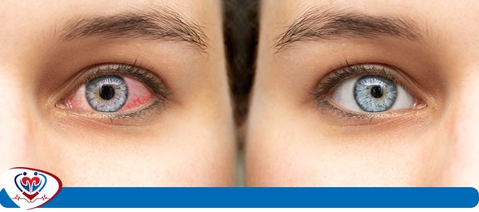 Pink Eye Treatment Clinic Near Me in Alexandria, and Ruther Glen, VA