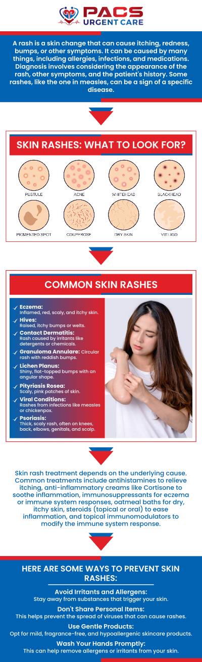 At PACS Urgent Care, our professionals provide personalized rash treatment to relieve discomfort and restore skin health. Whether you're dealing with eczema, psoriasis, or an allergic rash, Dr. Khaled Said, MD, and Dr. Walid Hammad can help diagnose and treat your condition with effective solutions. We focus on alleviating irritation and preventing flare-ups, helping you regain clear and healthy skin. For more information, please contact us or use our online check-in. We are conveniently located at 17067 Merchants Dr, Ruther Glen, VA 22546.
